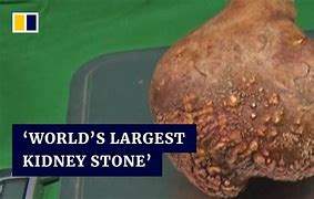 Image result for Largest Kidney Stone