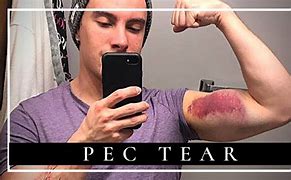 Image result for Pec Tear Bruising On Bicep