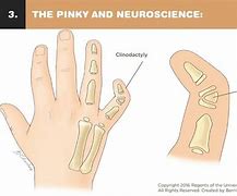 Image result for Pinky Finger Curling Up
