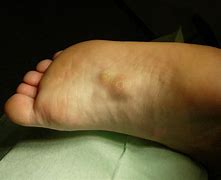 Image result for Lump On Arch of Foot Plantar Fibroma