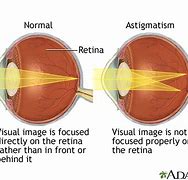 Image result for Astigmatism Real Human Eye