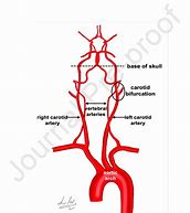 Image result for Vertebral Arteris and Carotid Arteries