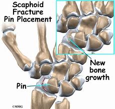 Image result for Scaphoid Fracture