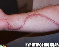 Image result for Meme Hypertrophic Scar On Arm