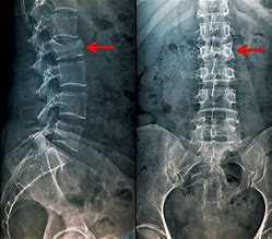Image result for Back Brace for Lumbar Compression Fracture