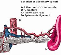 Image result for Accessory Spleen