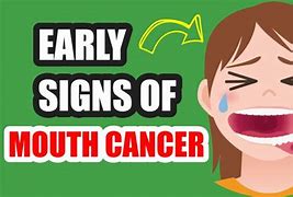 Image result for Sure Signs of Oral Cancer