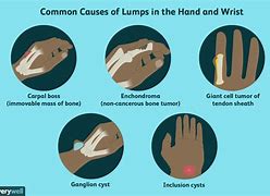 Image result for Lump Growing On Wrist