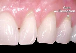 Image result for Minor Gum Recession