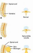 Image result for Spina Bifida Neural Tube