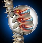 Image result for Lumbar Spine Disc Protrusion