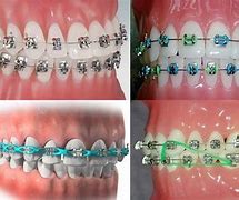 Image result for Straight Teeth with Braces