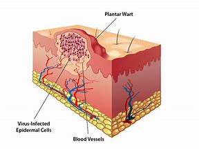 Image result for Anatomy of a Wart