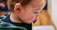 Image result for Baby Food Allergy
