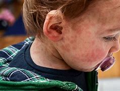 Image result for Child Allergies