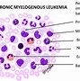 Image result for Leukemia Cell Structure