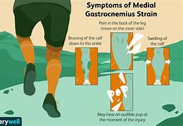 Image result for Gastrocnemius Muscle Tear Treatment