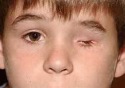 Image result for Anophthalmia