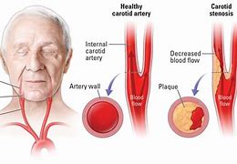 Image result for Carotid Artery Stenosis Symptoms