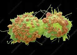 Image result for Ovarian Cancer Cells