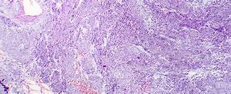 Image result for Fibroid Tissue
