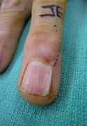 Image result for Mucous Cysts On Finger Joints
