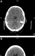Image result for Acute Hydrocephalus