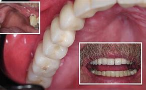 Image result for Upper Jaw Bone Augmentation Surgery