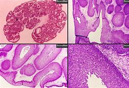 Image result for What Is an Inverted Papilloma