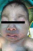 Image result for Trisomy 18 Syndrome Babies