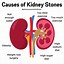 Image result for Apple Cider Vinegar Kidney Stones