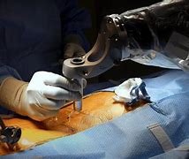 Image result for Robotic Spine Surgery