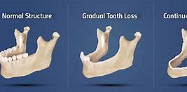 Image result for Jaw Bone Loss Progression