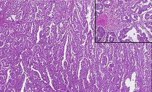 Image result for Mucinous Ovarian Carcinoma