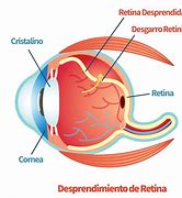 Image result for Problemas En La Retina