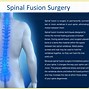 Image result for Spinal Fusion Procedure