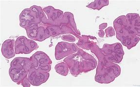 Image result for Laryngeal Papillomatosis