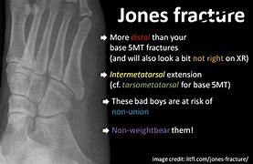Image result for Zone 1 Jones Fracture