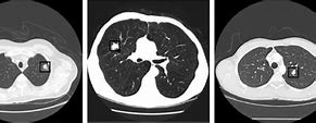 Image result for Types of Pulmonary Nodules
