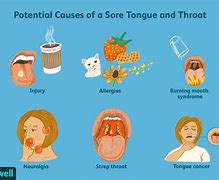 Image result for Dry Mouth Sore Throat