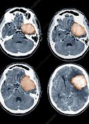 Image result for Brain Cancer CT Scan