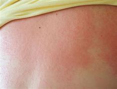 Image result for Skin Heat Rash