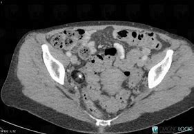 Image result for Dermoid Cyst CT