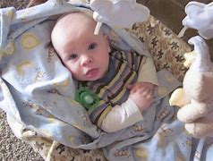Image result for Children with Lissencephaly