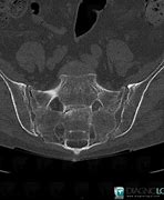 Image result for Sacrum Coccyx Fracture