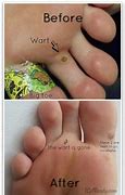 Image result for Dead Wart Removal