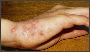 Image result for Shingles On Forearm