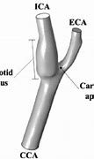 Image result for What Is the Carotid Bulb