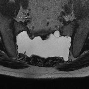 Image result for Sacral Meningocele Radiology
