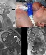 Image result for Teratoma